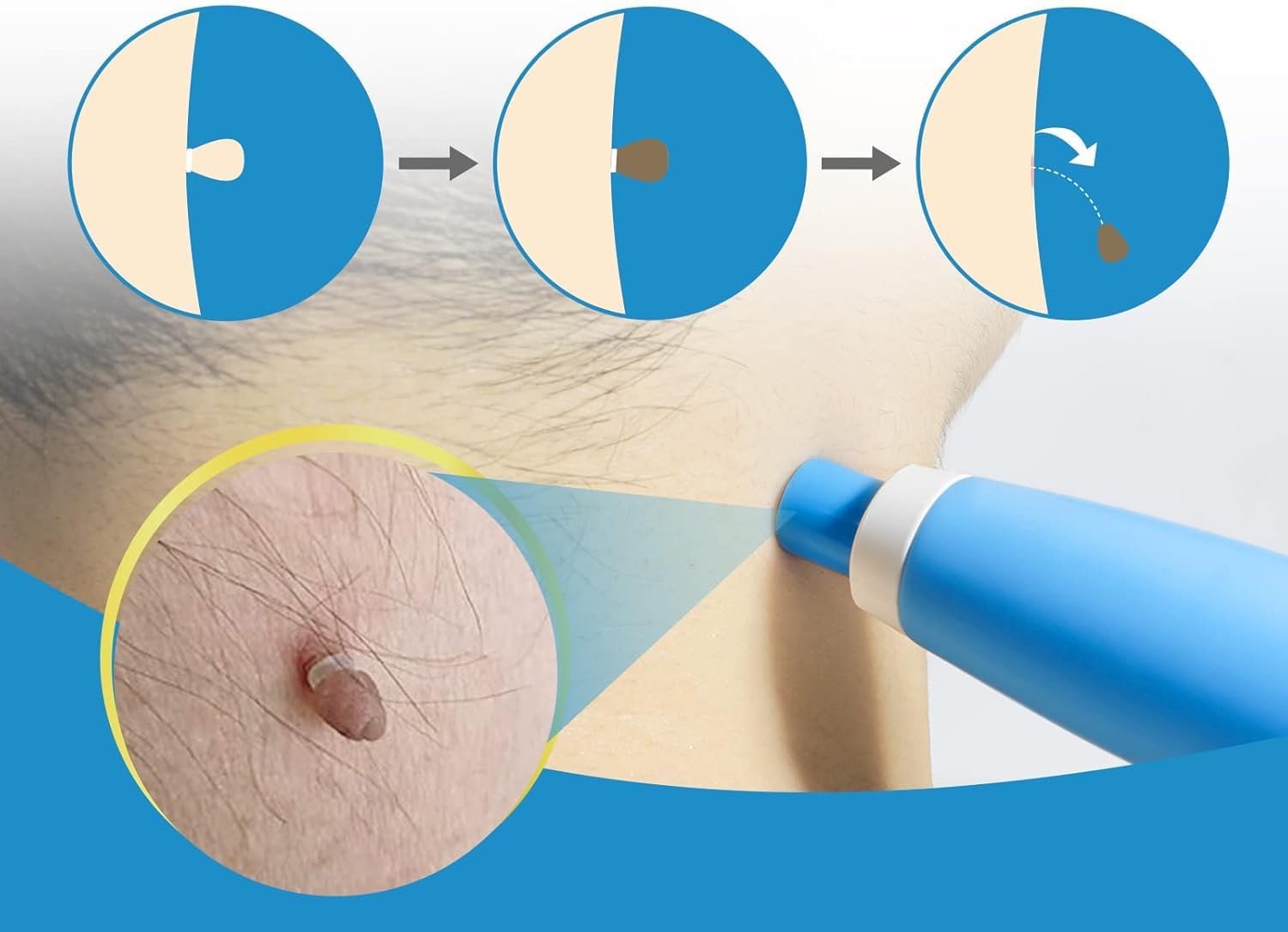 Painless Auto Skin Tag & Mole  - Health Wellness recension och pris