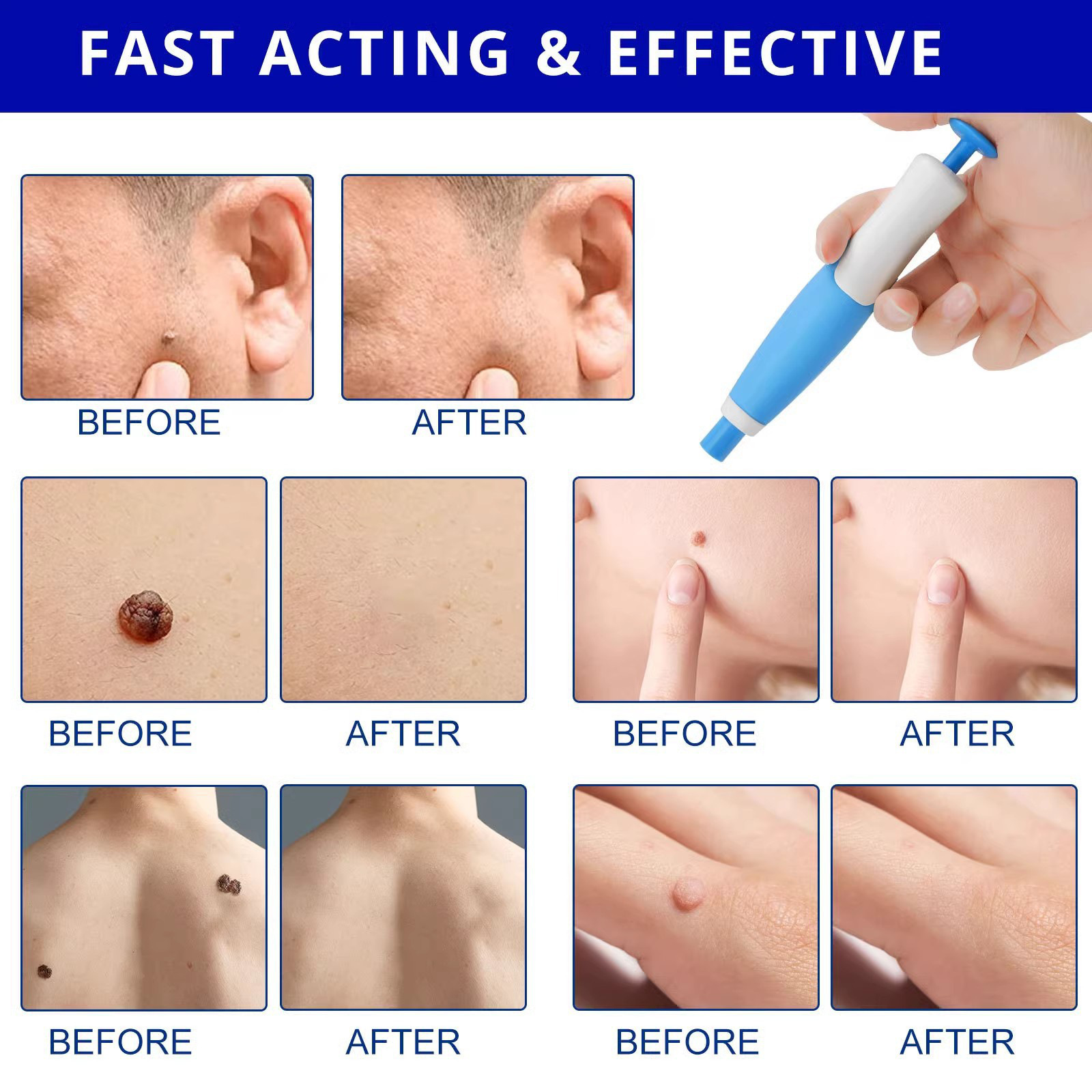 Painless Auto Skin Tag & Mole  - Health Wellness recension och pris