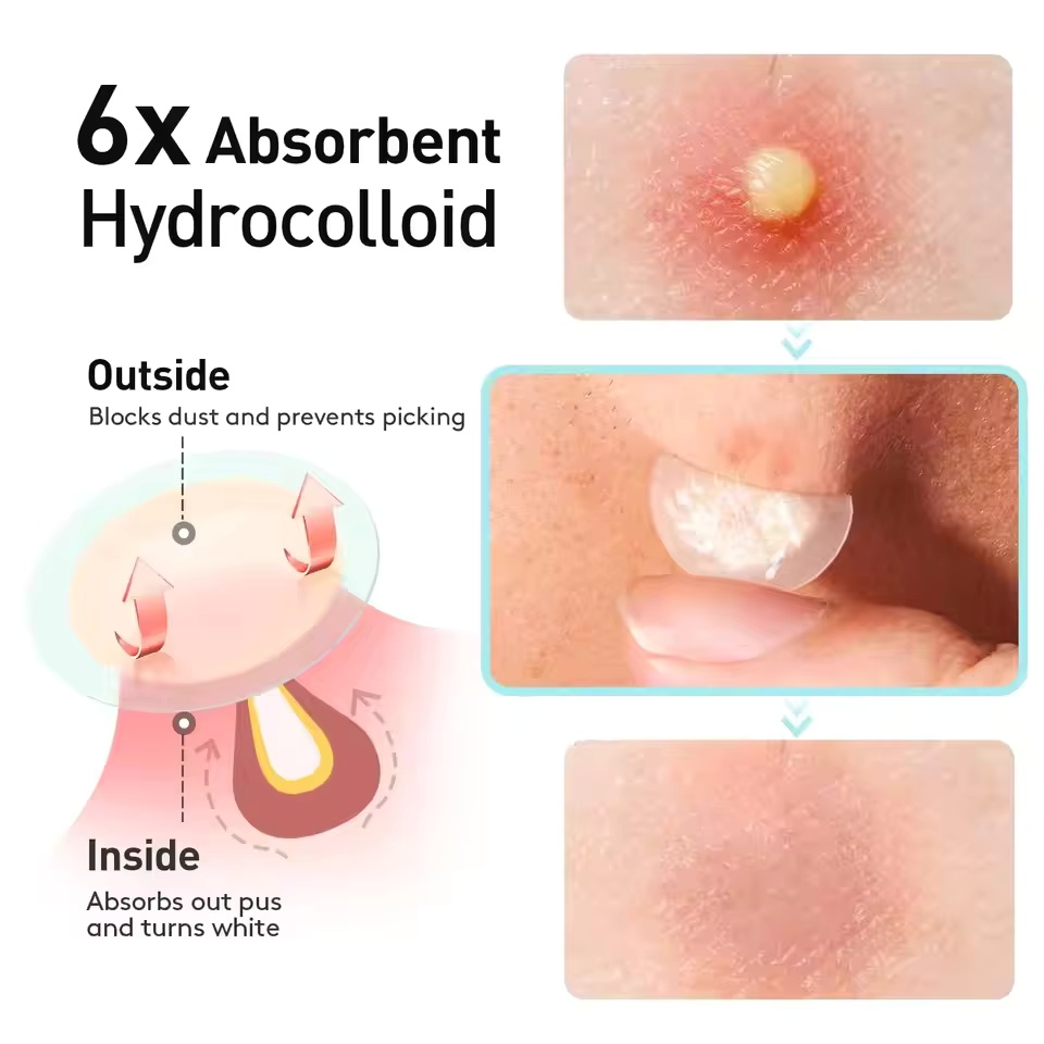 360 pieces/box acne patches -  - Essential Oils recension och pris